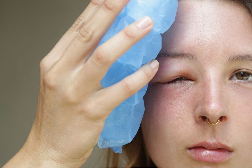 woman with a swollen eyelid