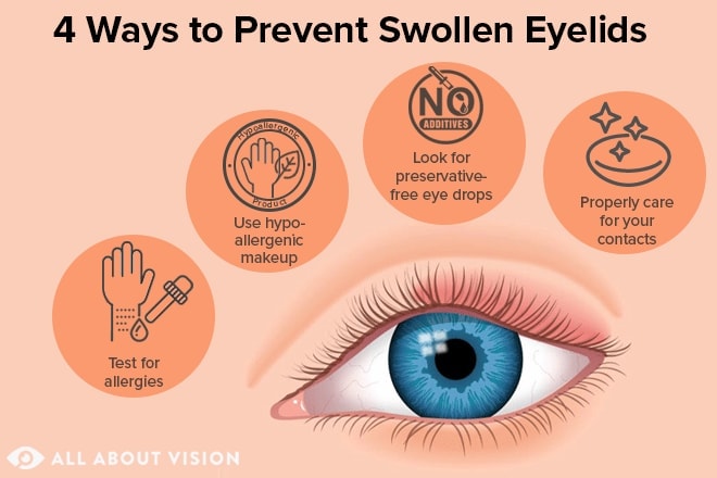 Swollen eyelid treatment and prevention Swollen eyelid treatment and prevention
