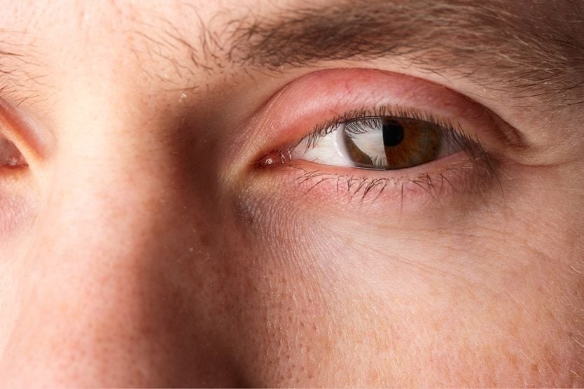 man with a swollen eyelid
