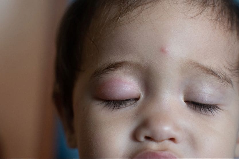 toddler with swollen eyelid