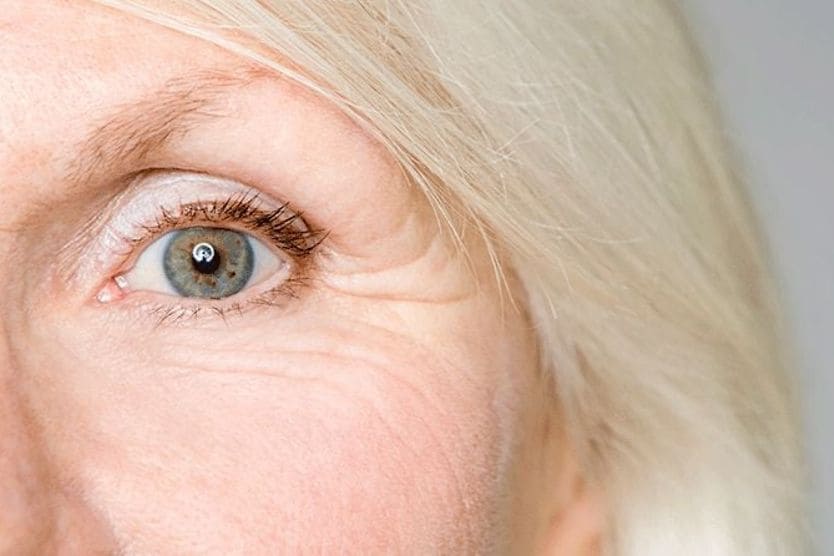 Crow’s feet: Causes, treatment and prevention older woman with crow's feet around her eye