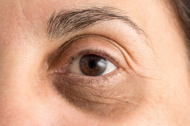 Dark circles under the eyes: Causes and how to get rid of them