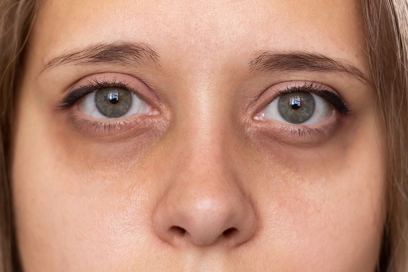 Dark circles under the eyes: Causes and how to get rid of them