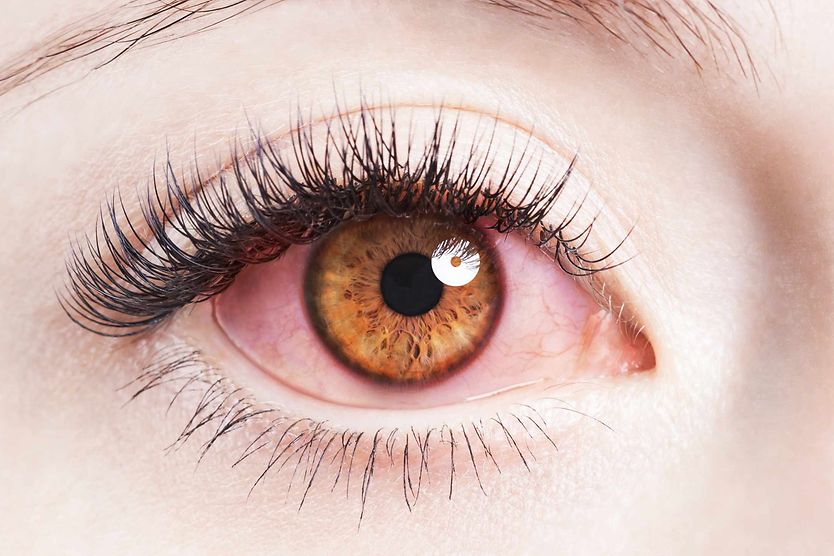 How do you treat an eye infection from makeup? closeup of an infected eye from makeup
