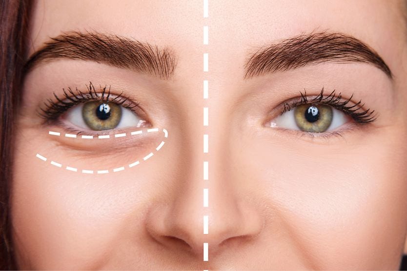 Tear trough filler Tear trough before and after