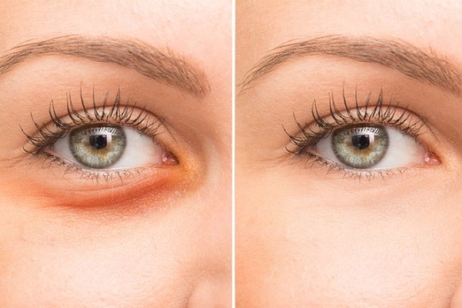 Under eye filler: Cost, safety and what to expect