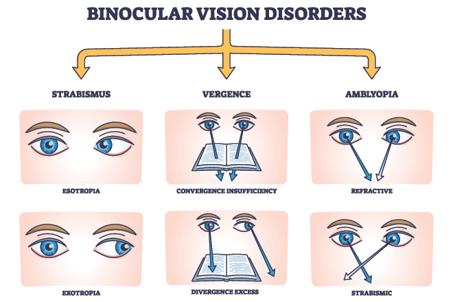 Binocular vision, eye teaming and binocular vision dysfunction