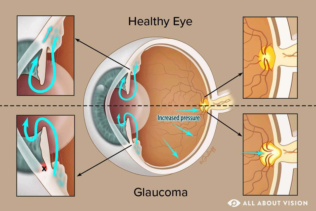 Optic Disc Optic Disc