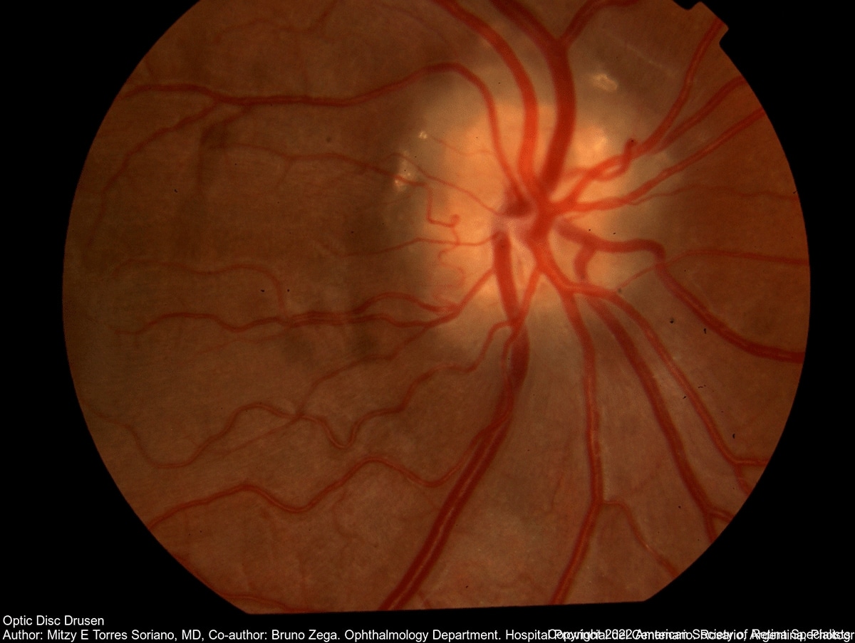 Optic Disc Optic Disc