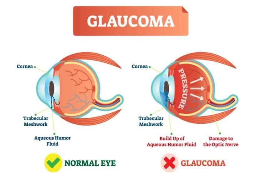 The role of the trabecular meshwork in eye fluid drainage Trabecular Meshwork depiction in a healthy eye v an eye with glaucoma.