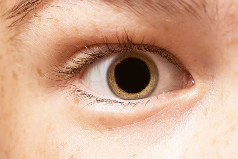 What not to do after eye dilation closeup of a dilated eye