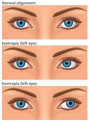 What is the corneal light reflex, and how is it examined?