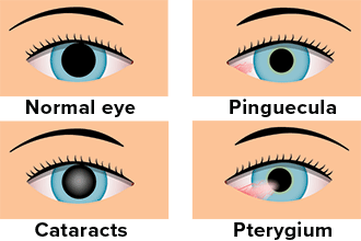 Is sun gazing safe for the eyes?