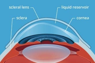 Contacts For Hard-To-Fit Eyes