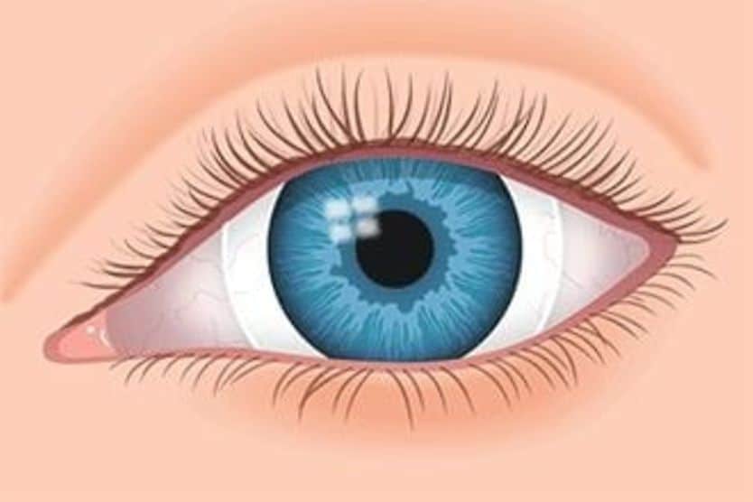 Contacts For Hard-To-Fit Eyes scleral lens in eye