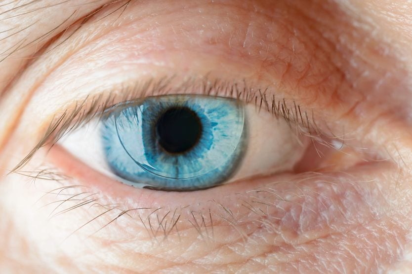 man wearing a PMMA contact lens