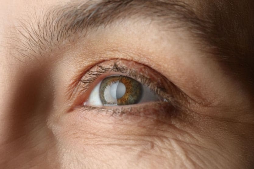 How To Find a Cataract Eye Surgery Specialist Near Me
