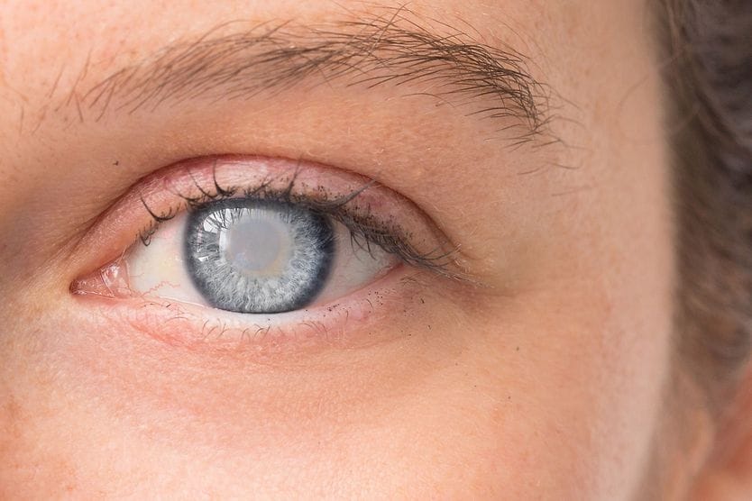 June is Cataract Awareness Month