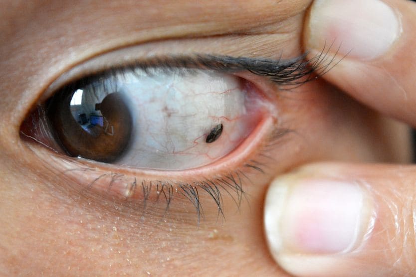 May is Ocular Melanoma Awareness Month Close-up of suspicious mole on Asian woman's eye.