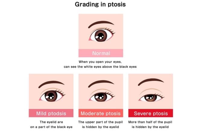 Grading in Ptosis Grading in Ptosis