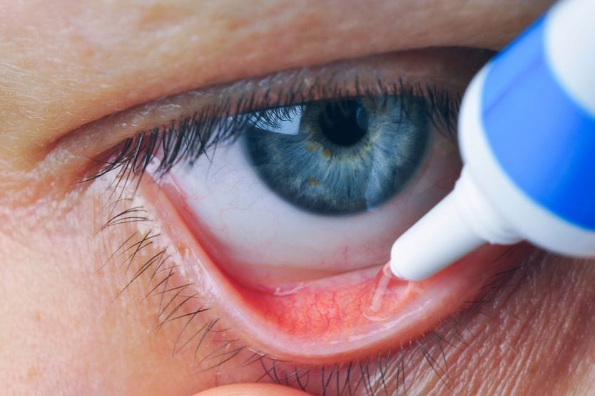 Ophthalmic ointment definition and uses Close-up image of ophthalmic ointment being applied to an eye.