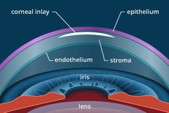 Vision surgery for presbyopia