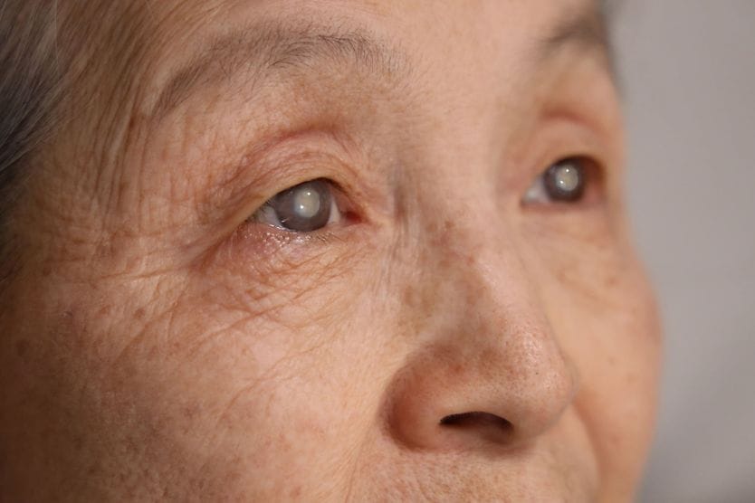 Closeup of an eye with a dense cataract