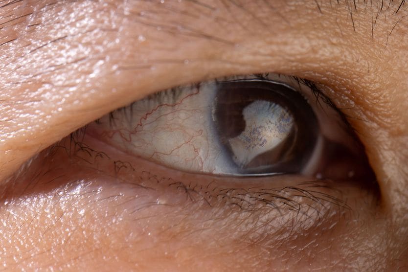 Cataracts Surgery