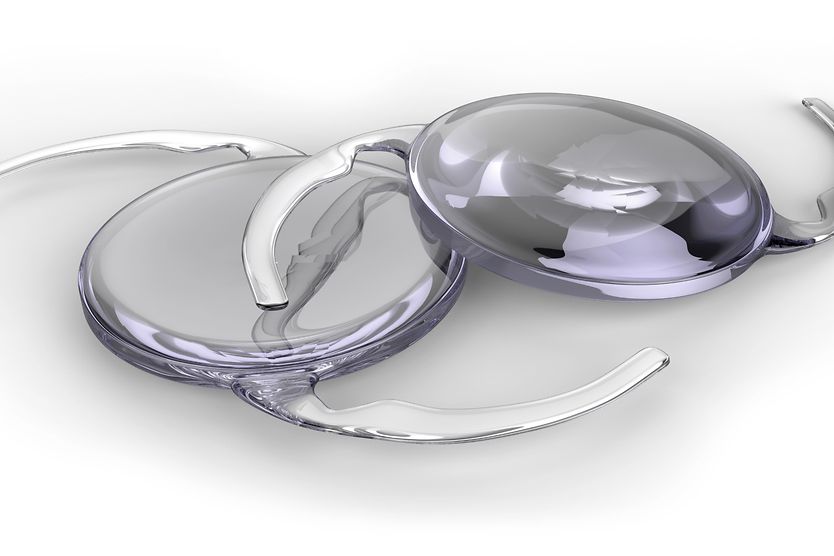 Monovision cataract surgery: Description and benefits monofocal iols for cataract surgery