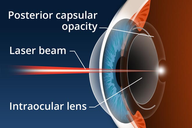 Posterior capsular opacification (secondary cataract) Posterior capsular opacification (secondary cataract)