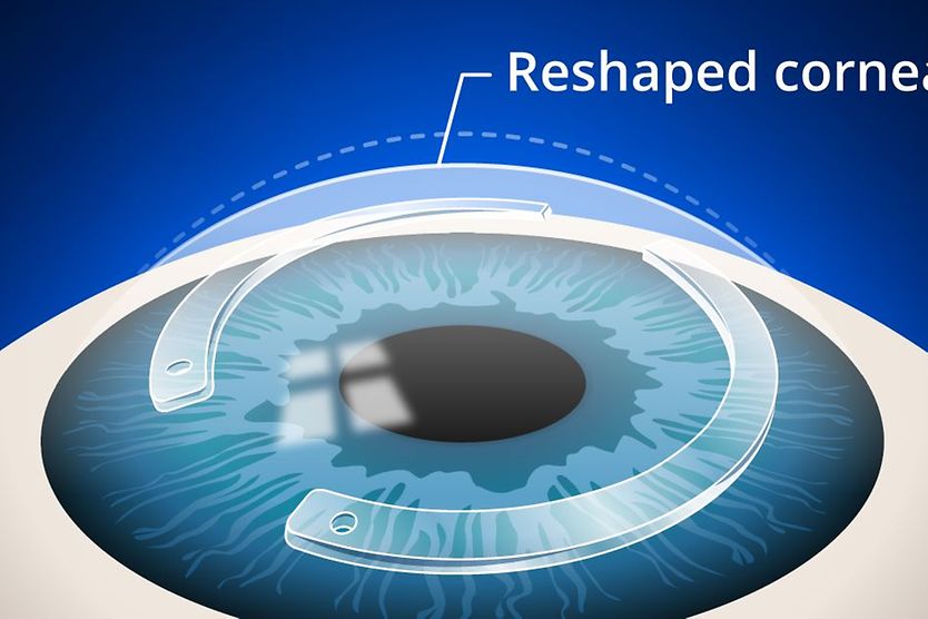 Intacs corneal inserts or implants: A proven treatment for keratoconus intacs corneal inserts procedure
