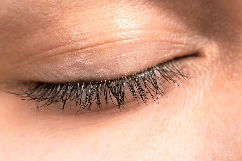 Tarsorrhaphy Depiction of an eyelid closed tight