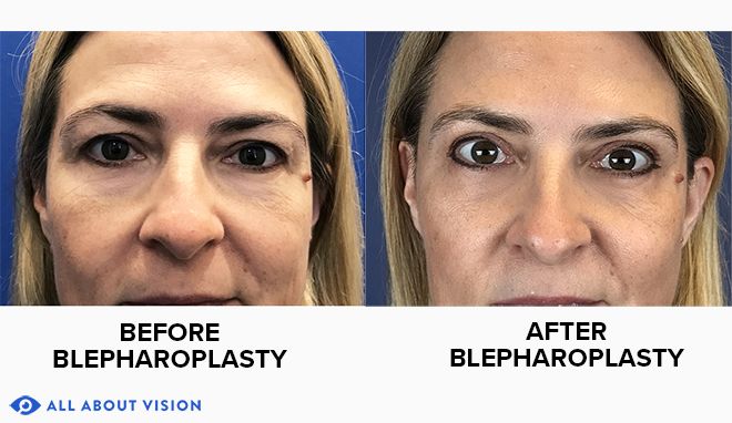 Blepharoplasty (Eyelid surgery) Blepharoplasty (Eyelid surgery)