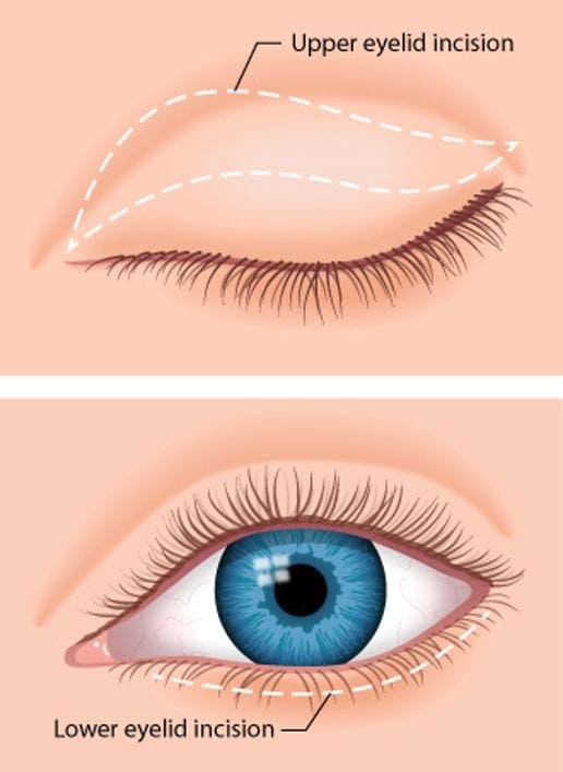 Blepharoplasty (Eyelid surgery) Blepharoplasty (Eyelid surgery)
