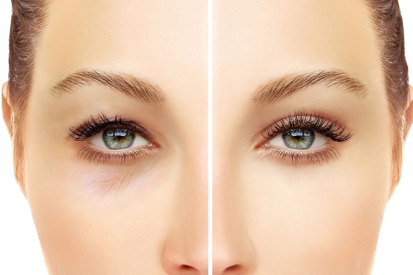 Blepharoplasty (Eyelid surgery) upper and lower eyelid blepharoplasty before and after pics