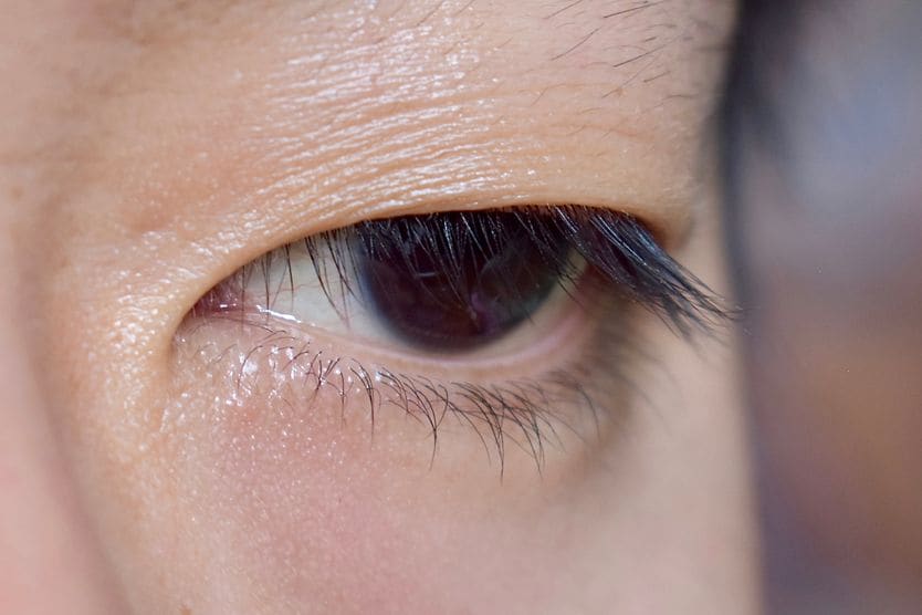 What is double eyelid surgery? closeup of a set of asian eyes before and after undergoing double eyelid surgery