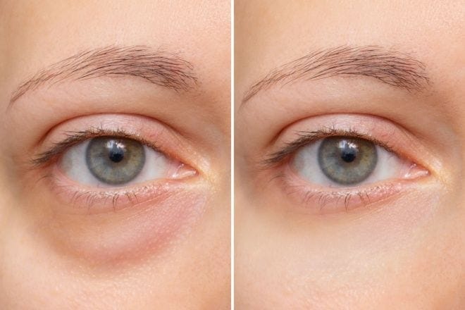 What is double eyelid surgery?