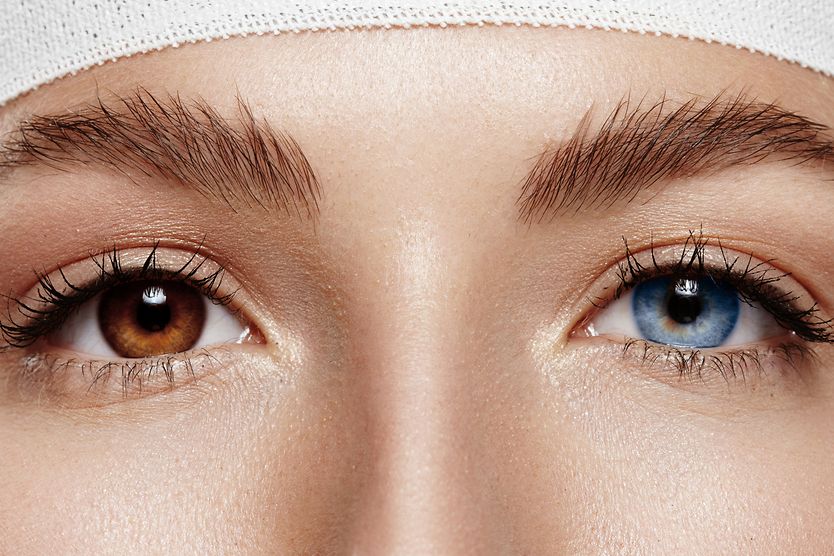 Eye color change surgery woman with an eye color change surgery with one blue eye and one brown eye