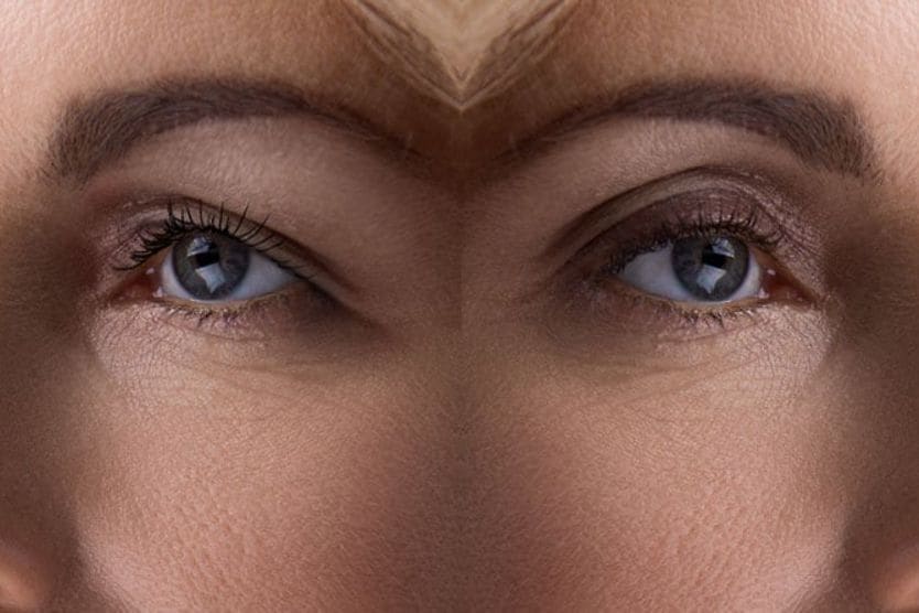 Eyelid surgery: What it is, how much it costs, what the risks are before and after side by side image of eyelid surgery
