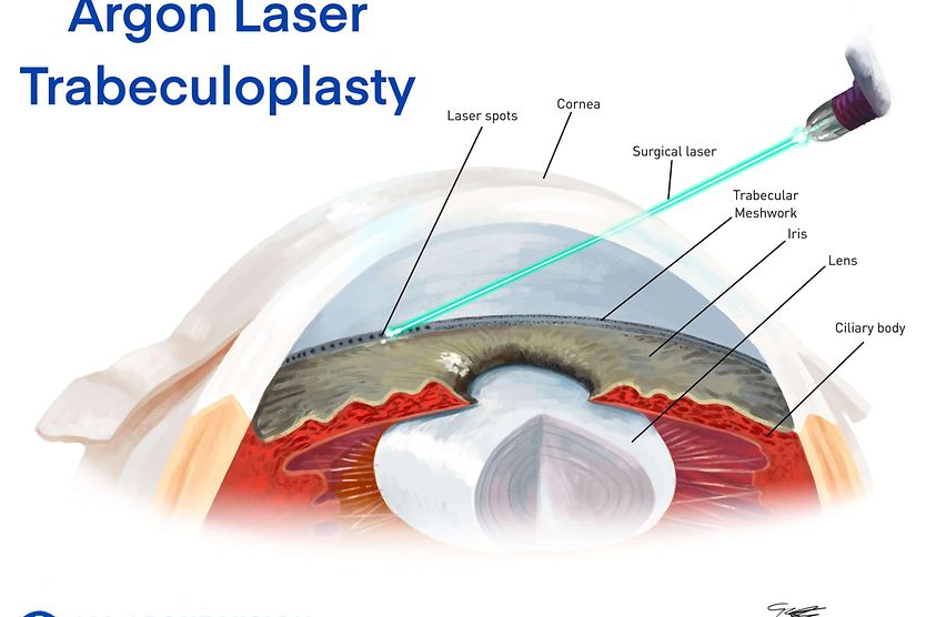 Illustration depicting effects of glaucoma surgery on the eye.