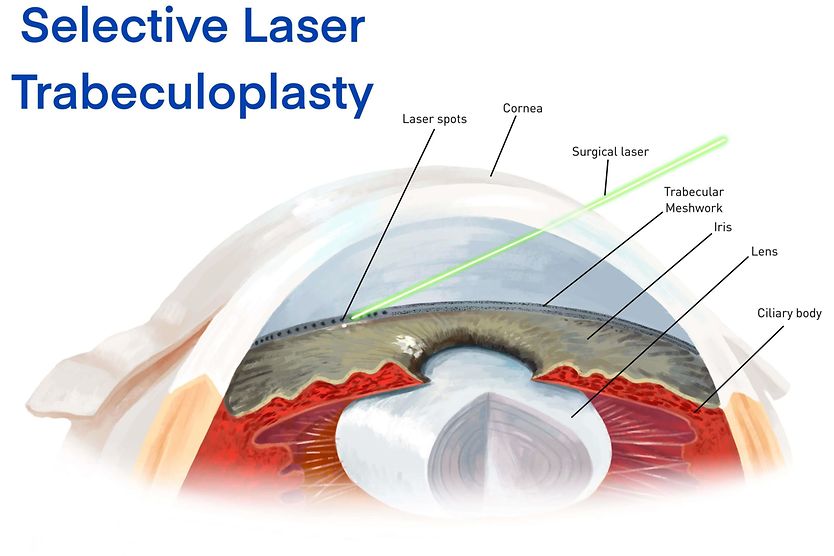 Glaucoma treatment: Eye drops, oral medications, surgery and more older man with glaucoma getting eye drops as glaucoma treatment
