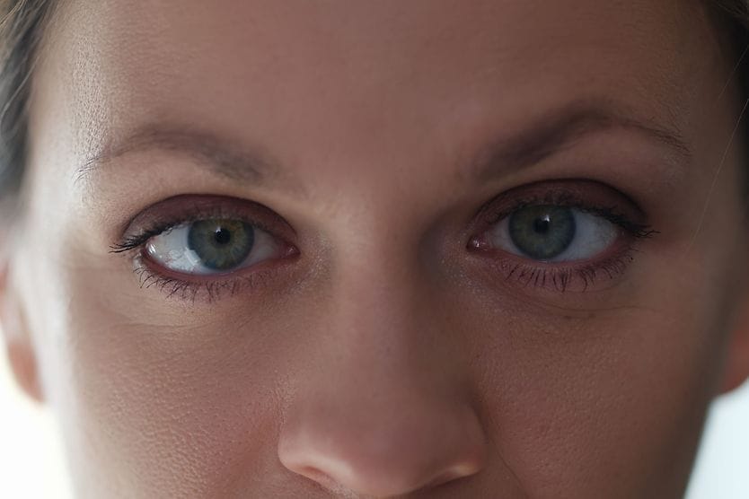 Amblyopia Portrait of young beautiful woman with lazy eyes.
