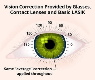 Custom Wavefront LASIK: Personalized vision correction Custom Wavefront LASIK: Personalized vision correction