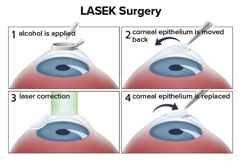LASEK eye surgery: How it works lasek surgery steps