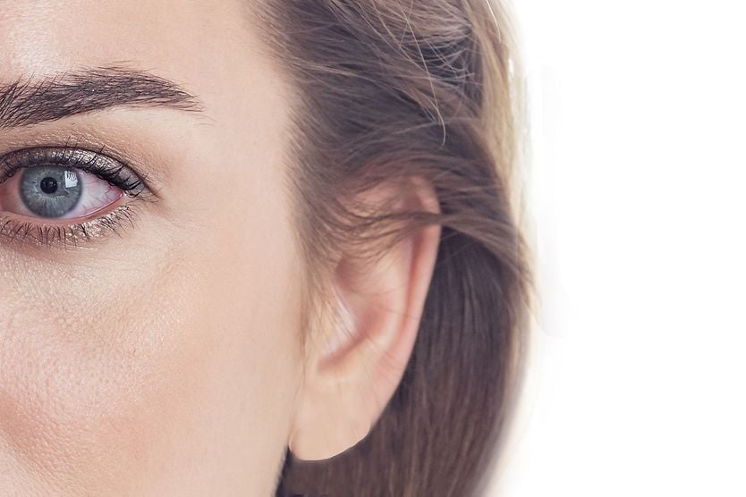 Dry eyes and LASIK Dry eye syndrome, female red eye with inflamed vessels close-up on a white background.