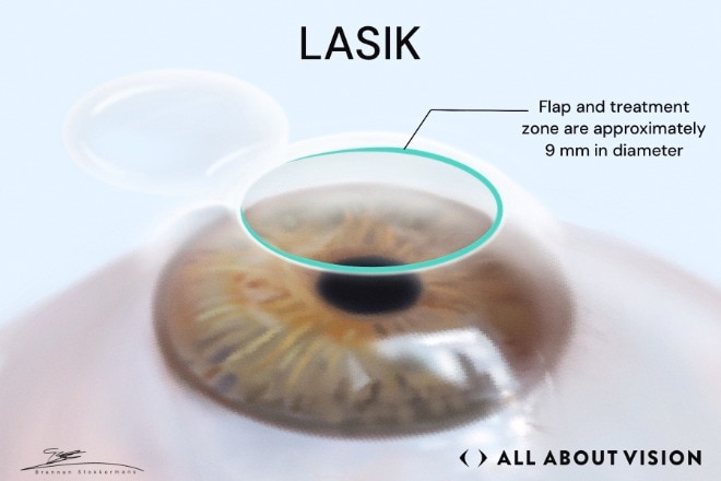 Lasik Eye Surgery
