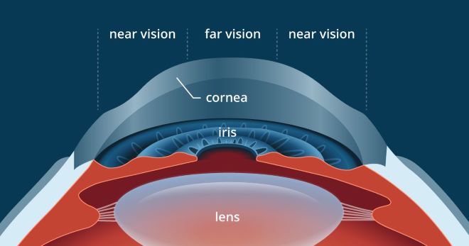 Surgery room for presbyLASIK