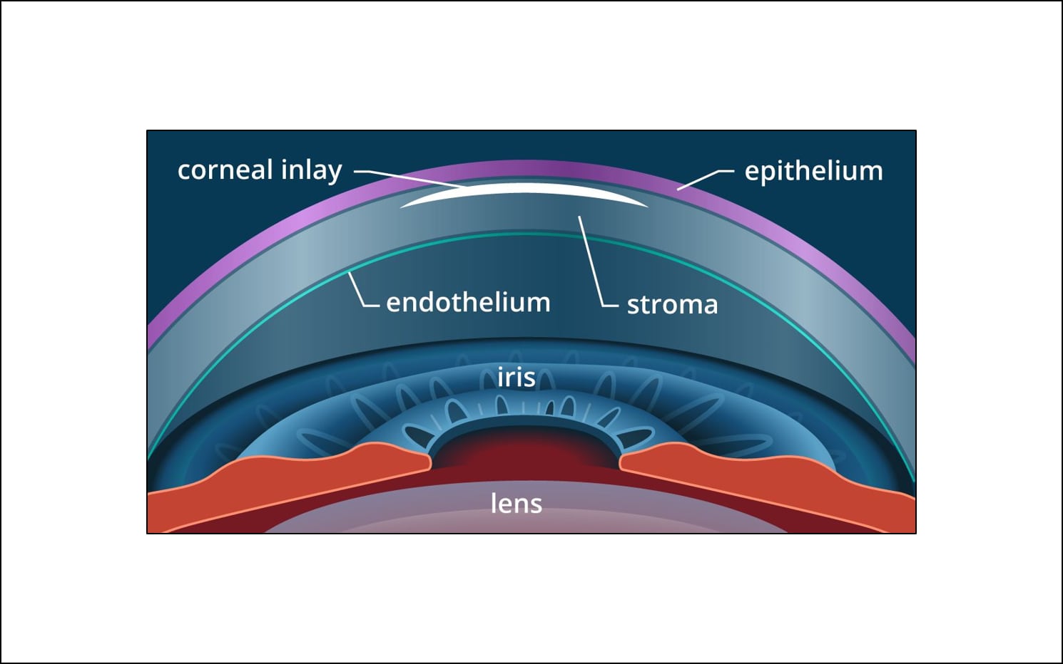 Presbyopia surgery