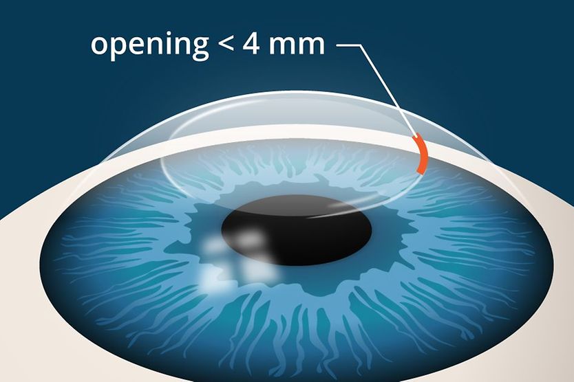 illustration of SMILE laser eye surgery incision