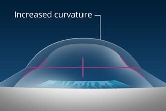 Conductive keratoplasty (CK) reduces need for reading glasses